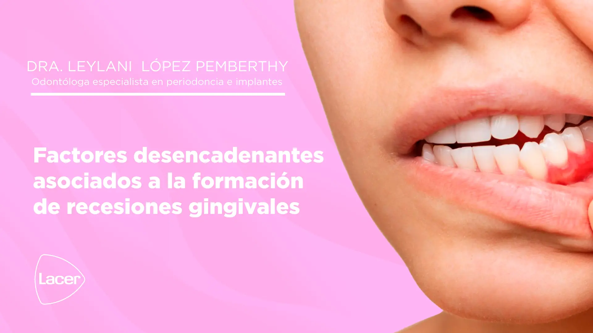 Factores desencadenantes asociados a la formación de recesiones gingivales, diagnóstico y tratamiento