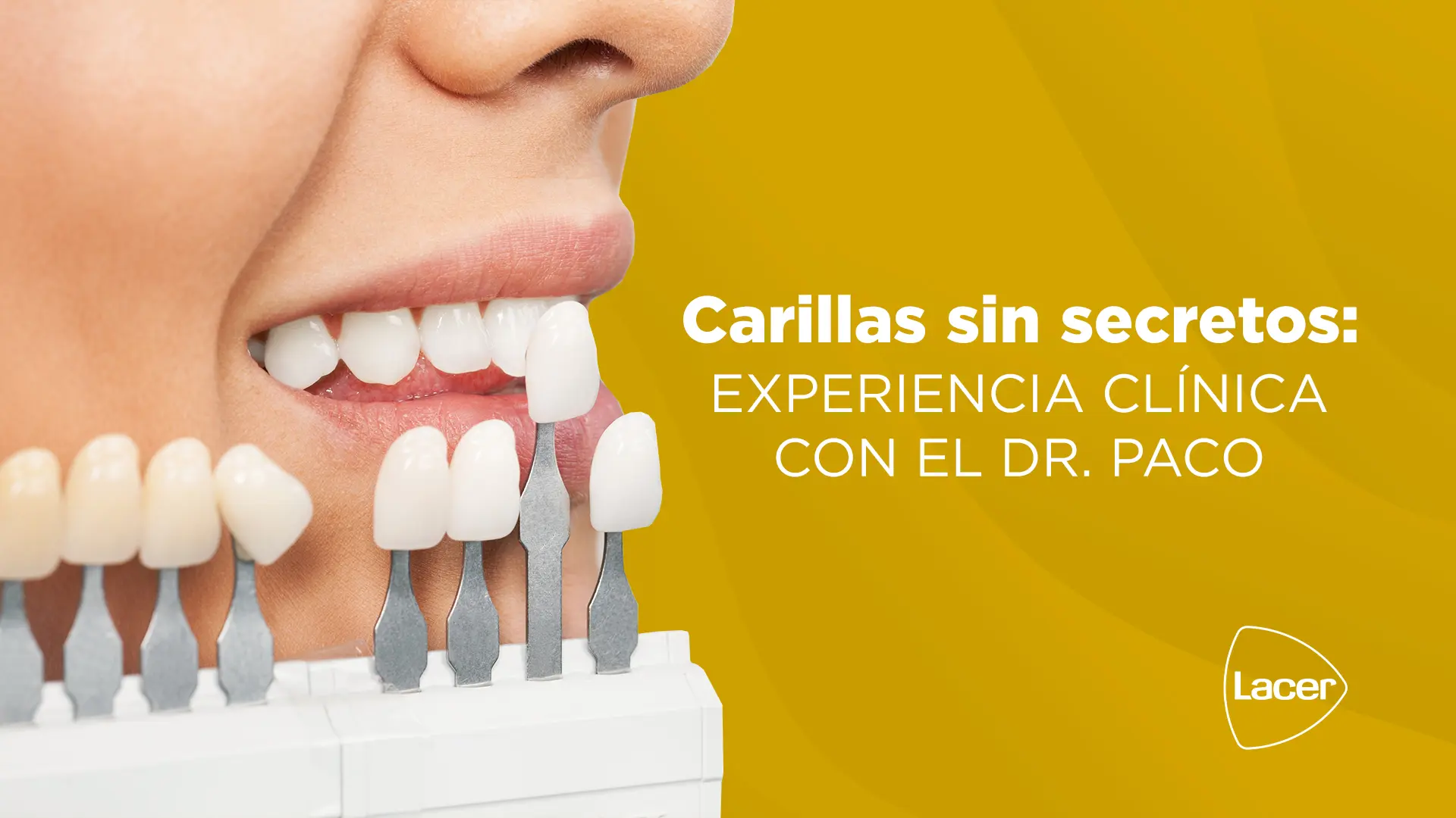 Carillas sin secretos: experiencia clínica con el Dr. Paco
