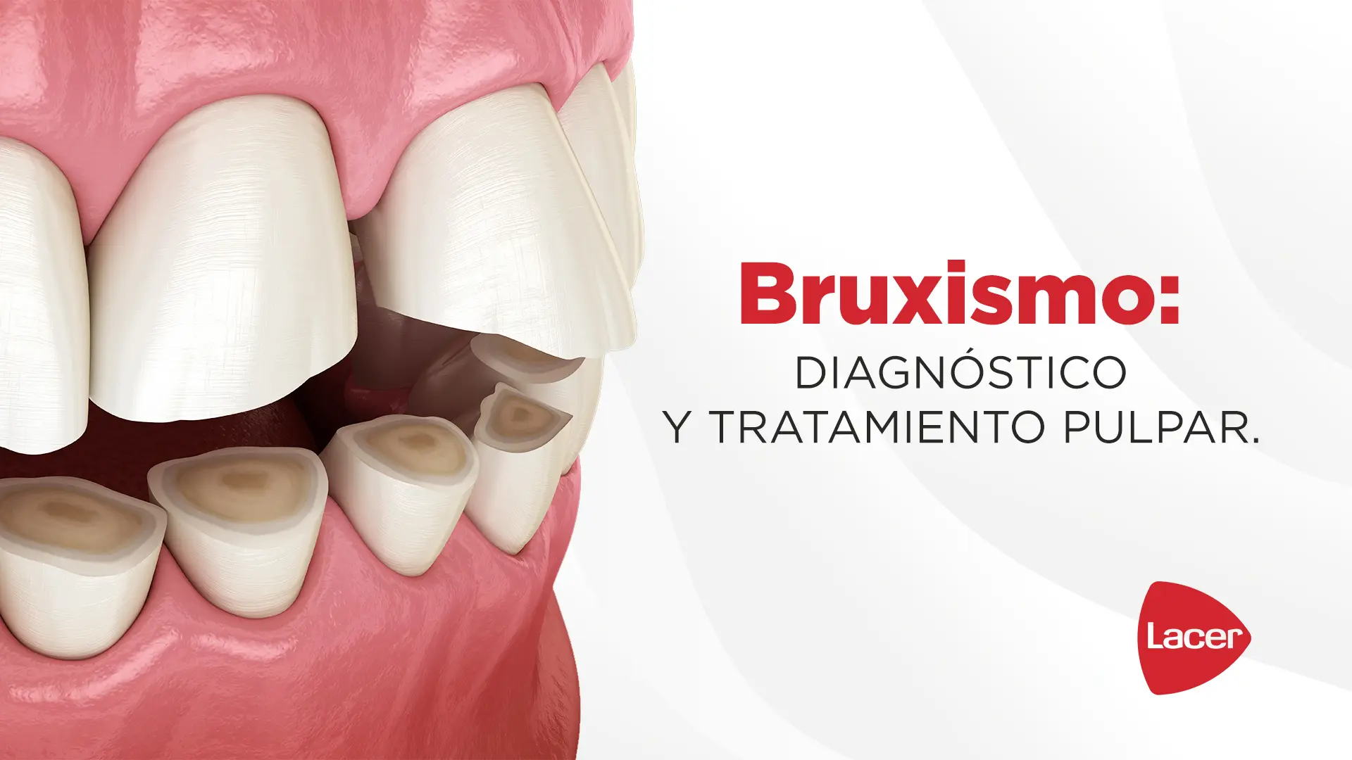 Bruxismo:Diagnóstico y tratamiento Pulpar.  Entendiendo el impacto del Bruxismo en la salud dental.